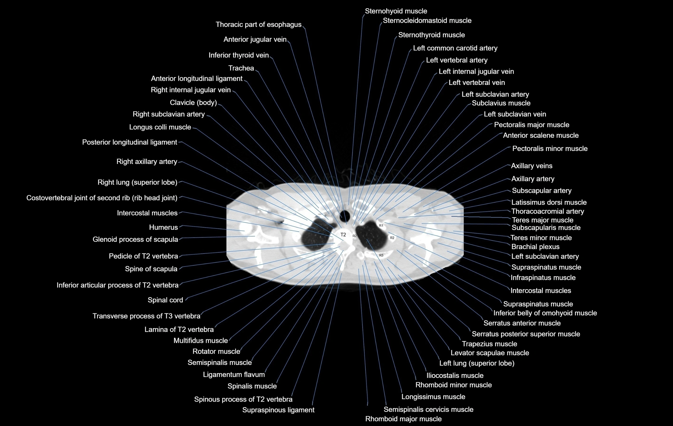 CT chest (thorax) labelled axial cross sectional anatomy radiology image-00011.webp